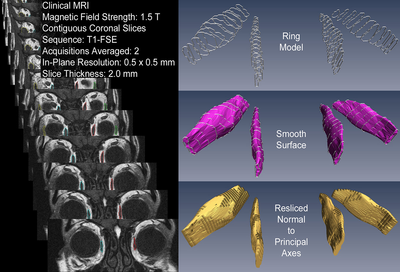 MRI Analysis Summary